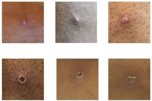 Information on monkeypox and our investigation into recent cases